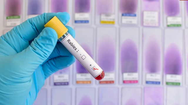 Bệnh dại có xét nghiệm được không? Các loại xét nghiệm bệnh dại hiện nay