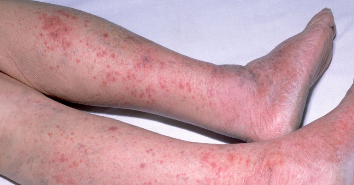 Bệnh não mô cầu